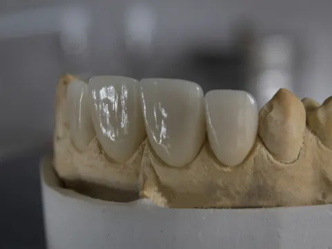 Ceramic crowns on a dental model